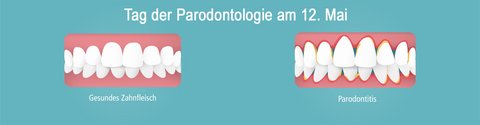 Parodontitis zeigt sich am Zahnfleisch